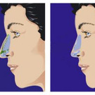 Rhinoplasty