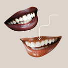 Veneers