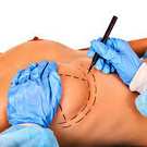 breast surgery