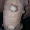 Patrixx5
