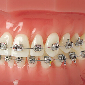 braces / брекеты
