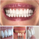 Veneers