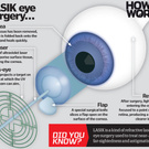 Lasik Eyes Surgery