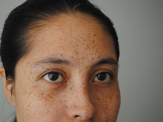 my freckles