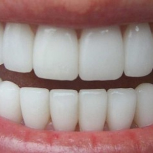 on braces