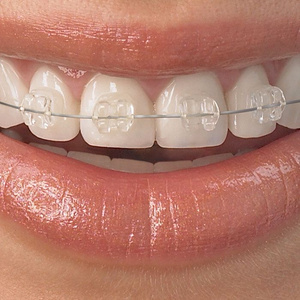 Брекеты braces