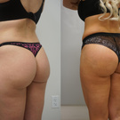 Brazilian buttlift