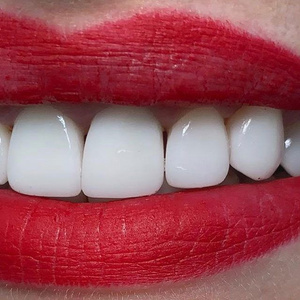 Veneers.