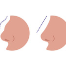 Rhinoplasty