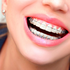 ровные зубы / straight teeth
