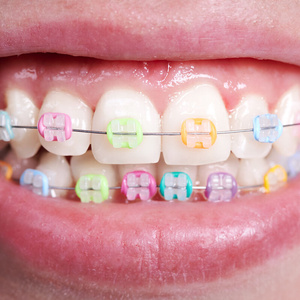 Braces
