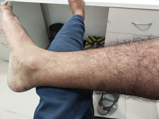 Hairy legs
