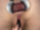 Anal gape