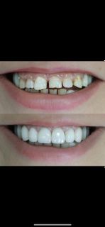 On the teeth