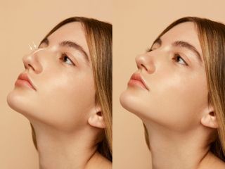 RHINOPLASTY❤️