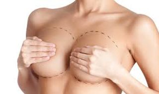 TO HAVE BREAST AUGMENTATION