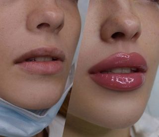 big lips