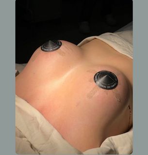 Mammoplasty