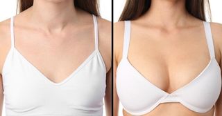 Breast Augmentation