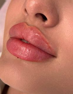 enlarge lips