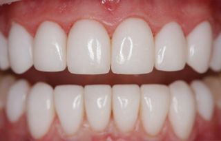 Veneers